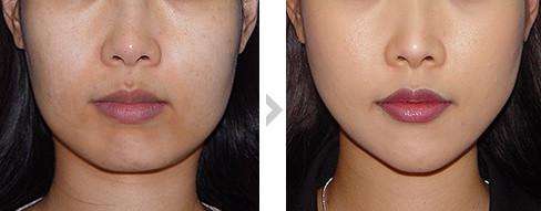 做面部吸脂皮膚會變松弛嗎？把抗衰正確的寫進(jìn)日程里