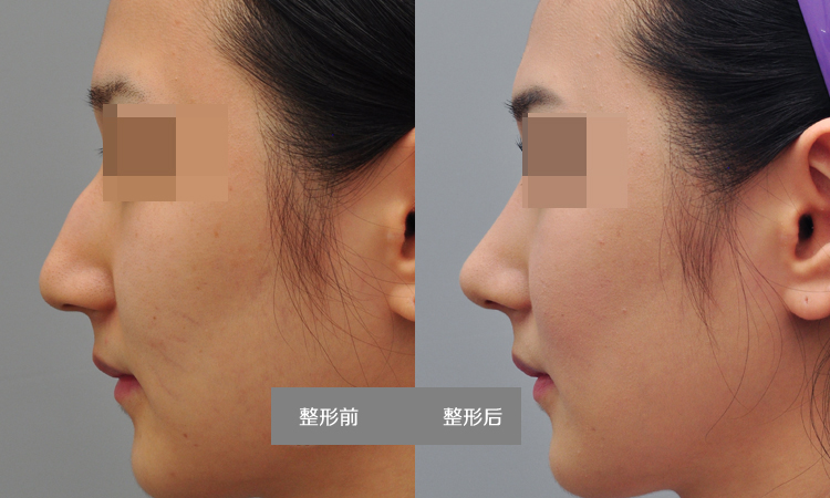 術(shù)前了解一下：駝峰鼻整形費(fèi)用大概多少錢？