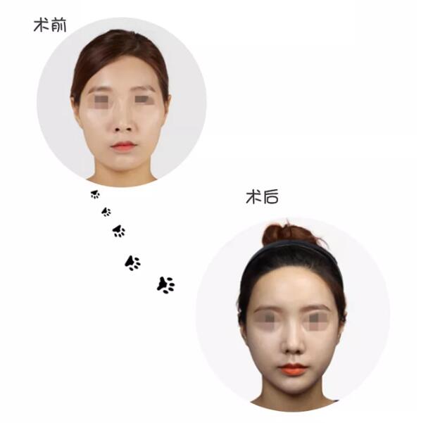 顴骨顴弓內(nèi)推手術(shù)注意事項