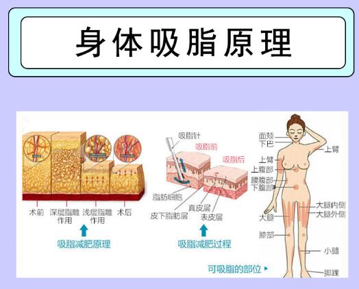 全身吸脂手術(shù)果好不好?