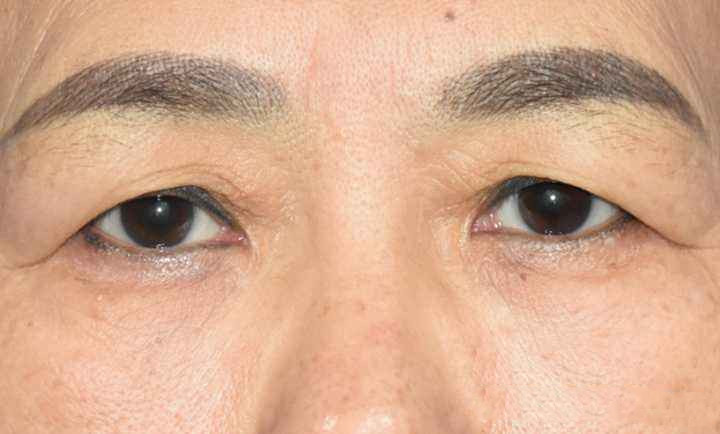 上眼皮松弛切除手術多少錢？術后果圖你品一品
