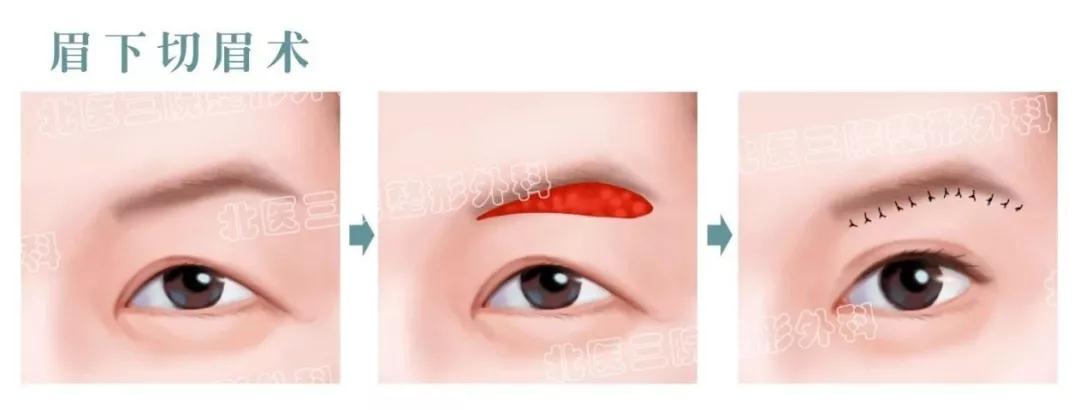 上眼皮松弛切除手術多少錢？術后果圖你品一品