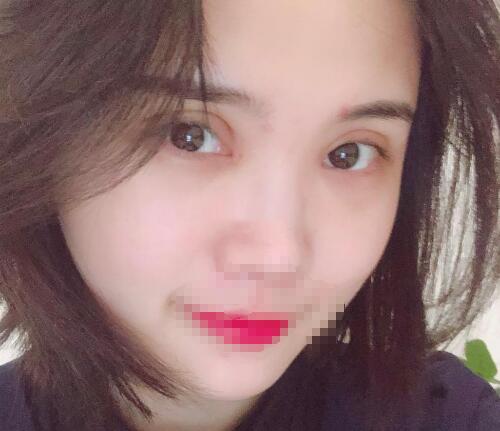 開灤總醫(yī)院整形美容科雙眼皮案例