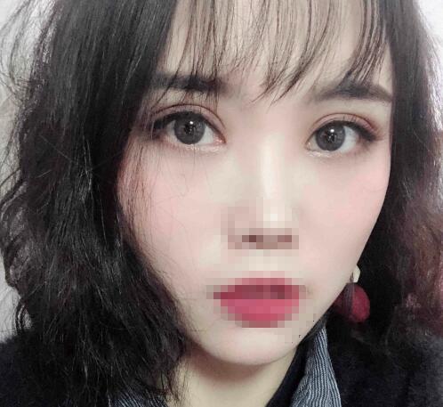 開灤總醫(yī)院整形美容科割雙眼皮多少錢