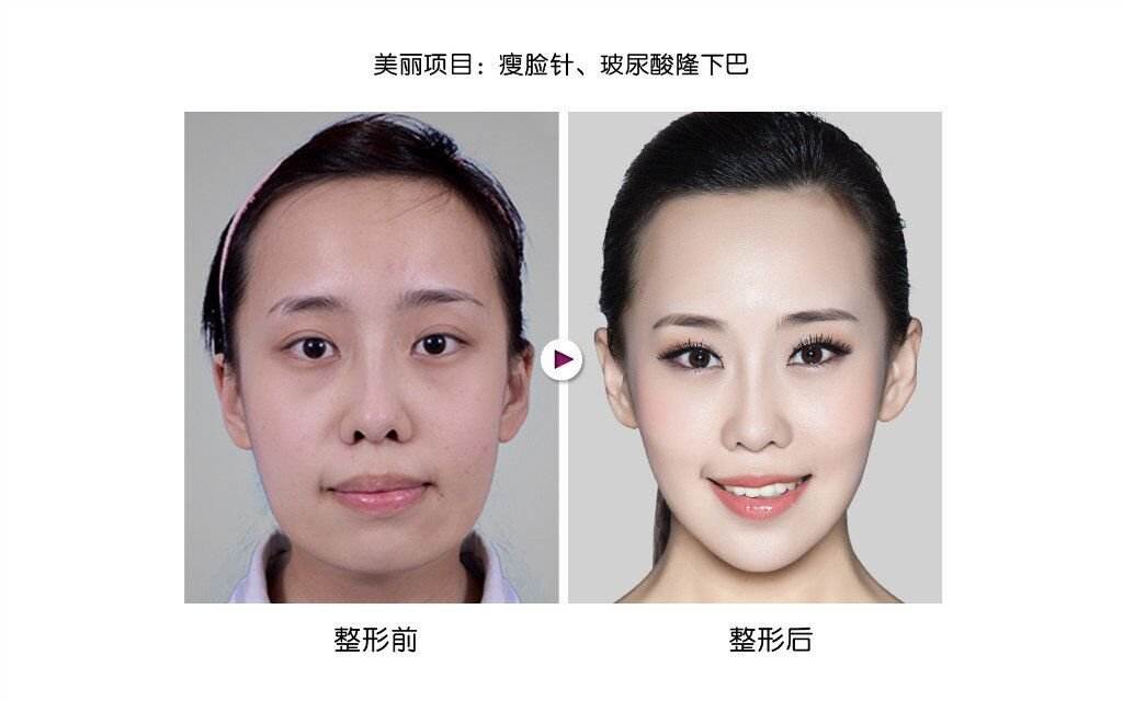 注射瘦臉多久打一次比較好？頻繁注射注射瘦臉會(huì)有副作用嗎？