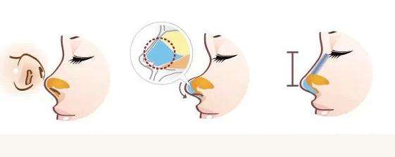 鼻頭塑形是什么項目？精致的鼻子鼻頭好看很重要！