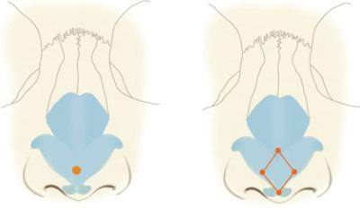鼻頭塑形是什么項目？精致的鼻子鼻頭好看很重要！