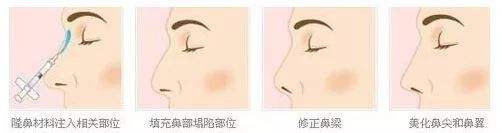 鼻頭塑形是什么項目？精致的鼻子鼻頭好看很重要！