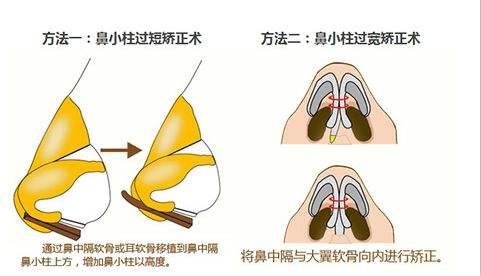 鼻頭塑形是什么項目？精致的鼻子鼻頭好看很重要！