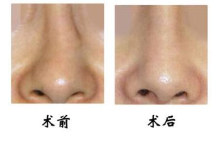 鼻梁歪整形手術(shù)果，讓你的鼻子“改邪歸正”