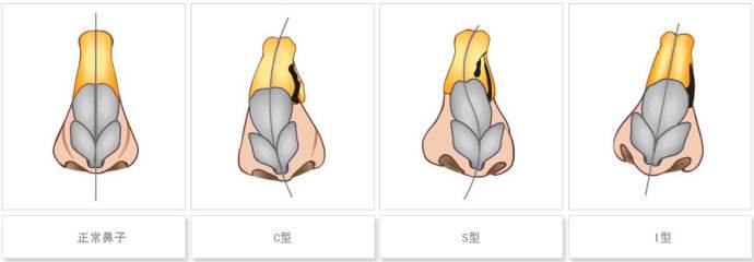 鼻梁歪整形手術(shù)果，讓你的鼻子“改邪歸正”
