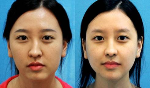 鼻梁歪整形手術(shù)果，讓你的鼻子“改邪歸正”