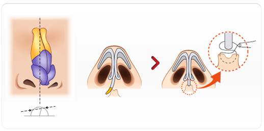 鼻梁歪整形手術(shù)果，讓你的鼻子“改邪歸正”