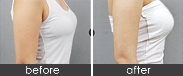 假體隆胸方法靠譜嗎、沒問題嗎？你想知道的都在這兒