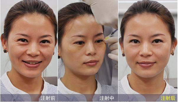 消除魚尾紋的方法有哪些？別信網(wǎng)上那些小偏方啦！