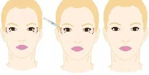 消除魚尾紋的方法有哪些？別信網(wǎng)上那些小偏方啦！