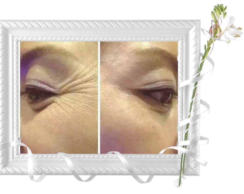 消除魚尾紋的方法有哪些？別信網(wǎng)上那些小偏方啦！