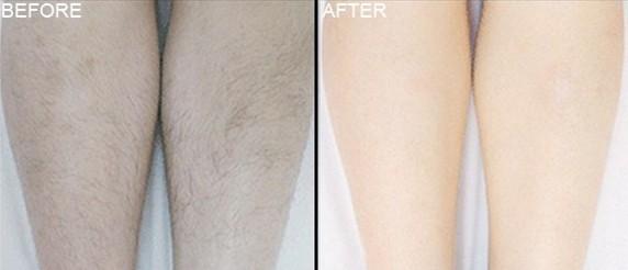 怎么樣脫毛才能夠沒(méi)問(wèn)題又徹底？這個(gè)方法可以一勞永逸！