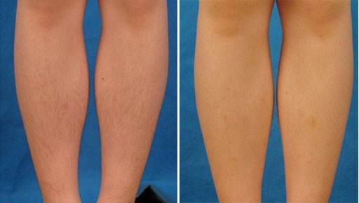 怎么樣脫毛才能夠沒(méi)問(wèn)題又徹底？這個(gè)方法可以一勞永逸！