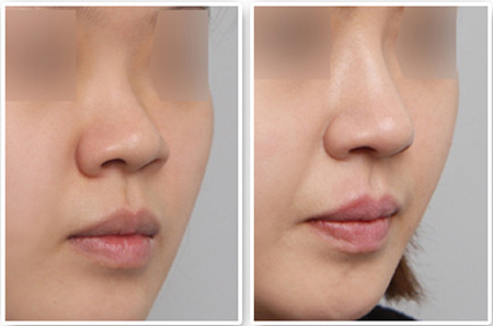 只想隆鼻，醫(yī)生還讓做鼻尖成形術？是被坑了嗎…