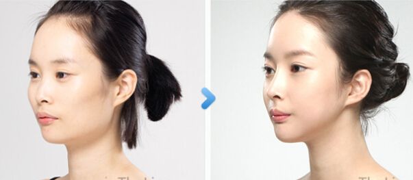 只想隆鼻，醫(yī)生還讓做鼻尖成形術？是被坑了嗎…