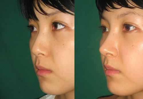 只想隆鼻，醫(yī)生還讓做鼻尖成形術？是被坑了嗎…