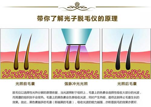 光子脫毛的危害