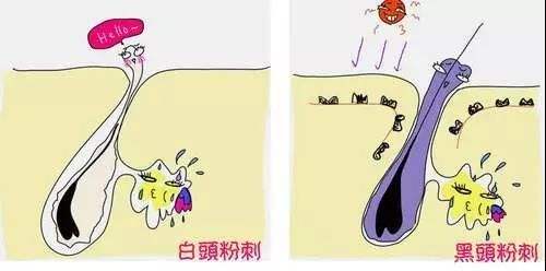 光子調(diào)節(jié)痤瘡需要幾次？術(shù)后注意事項(xiàng)