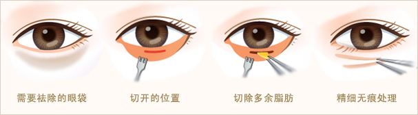 盤點(diǎn)一下抽脂去眼袋費(fèi)用 果和維持時(shí)間