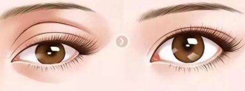 眼窩脂肪填充手術(shù)有硬塊怎么辦?