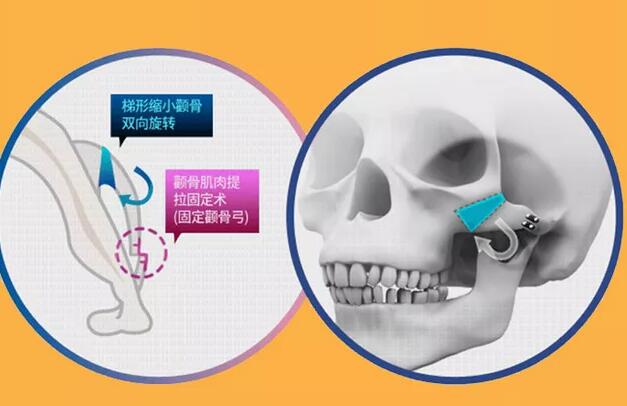 磨顴骨手術(shù)需要修復(fù)嗎?