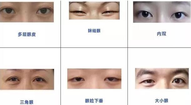 內(nèi)雙可以割雙眼皮嗎？看看專家怎么說(shuō)