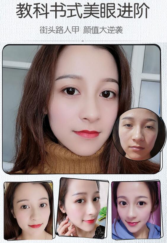 廣州海峽雙眼皮案例