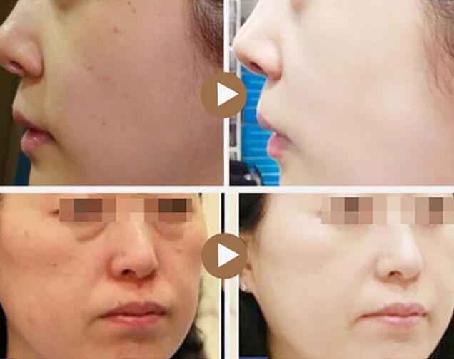 激光嫩膚后遺癥