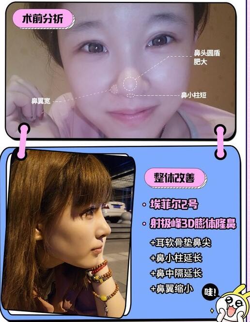 王旭明隆鼻案例