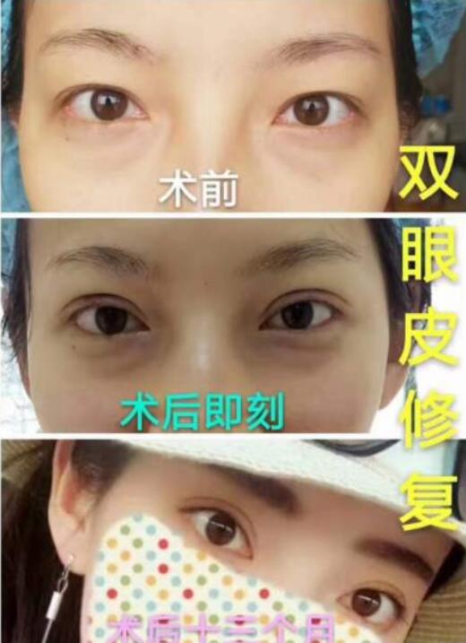 青海省人民醫(yī)院劉世杰醫(yī)生雙眼皮修復(fù)案例