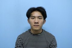 鼻翼寬大，做完鼻骨縮小手術(shù)后鼻子真的精致不少!