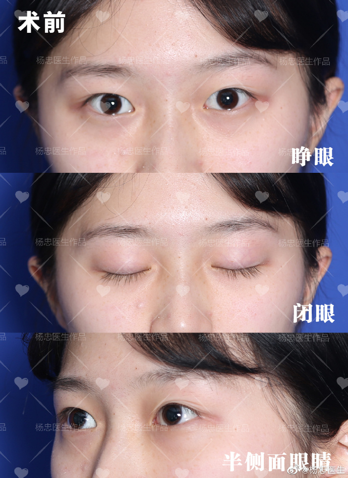 楊忠醫(yī)生雙眼皮案例圖