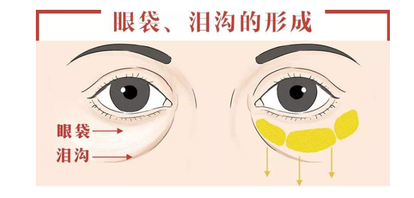 去眼袋和黑眼圈一步到位，這個(gè)方法可行！