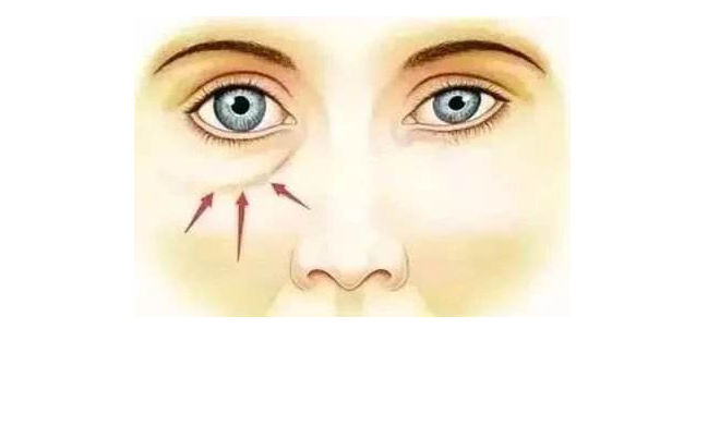 去眼袋和黑眼圈一步到位，這個(gè)方法可行！