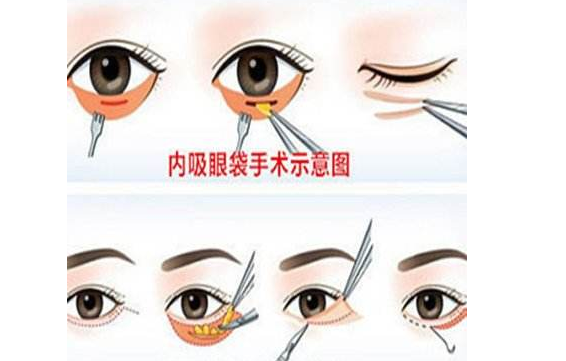 去眼袋和黑眼圈一步到位，這個(gè)方法可行！