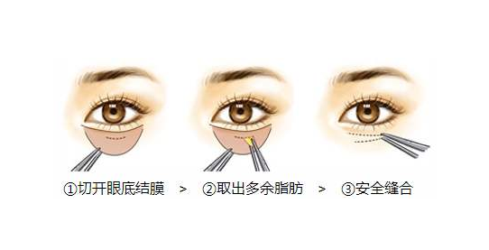 去眼袋和黑眼圈一步到位，這個(gè)方法可行！