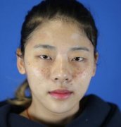 林秋蓉激光祛斑果太贊！終于擺脫“斑花”稱(chēng)號(hào)了！