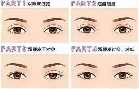 微創(chuàng)雙眼皮多久恢復(fù)自然