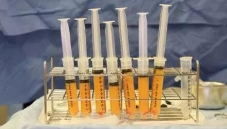 脂肪填充眉弓優(yōu)勢(shì)