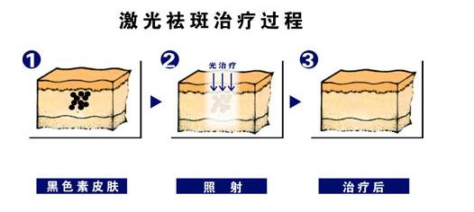 c6激光祛斑果是否理想？手術(shù)原理解析！