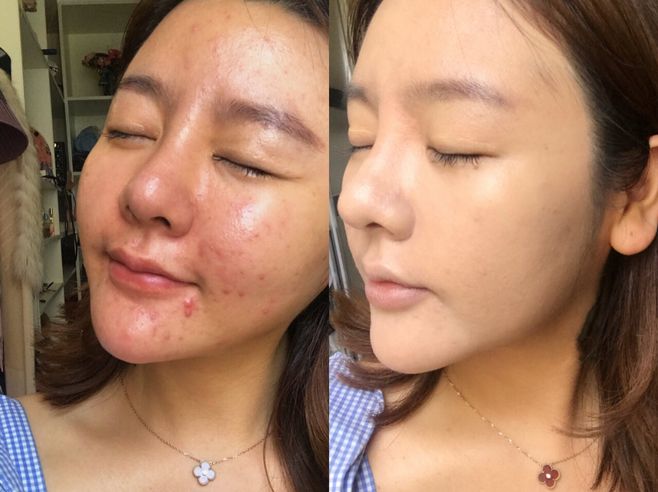 激光祛斑c6注意事項(xiàng)