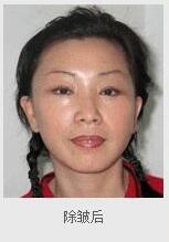 注射除皺的價(jià)位