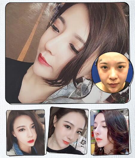 廣州海峽整形案例