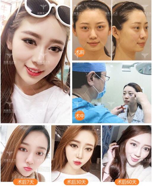 填充式注射除皺